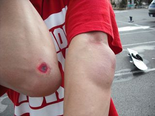 ヒジが大変な事に！